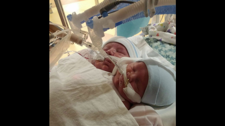 Couple Welcome Conjoined Twins, Abortion ‘Wasn’t an Option’