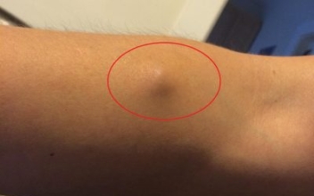 Redditor Finds Something Really Odd in His Arm