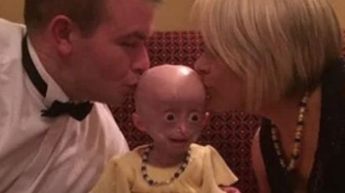 8-Year-Old Girl Dies From Extremely Rare Progeria as Tributes Pour In