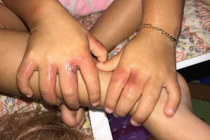 Toddler’s Beach Birthday Party Results in Hospital Visit, Florida Mother Says