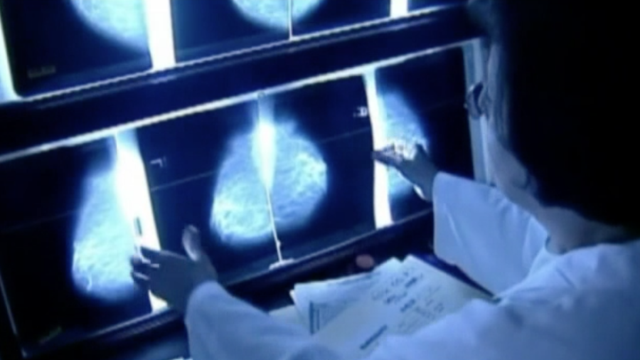 Breast Cancer Recurrence Drug Approved for Australia