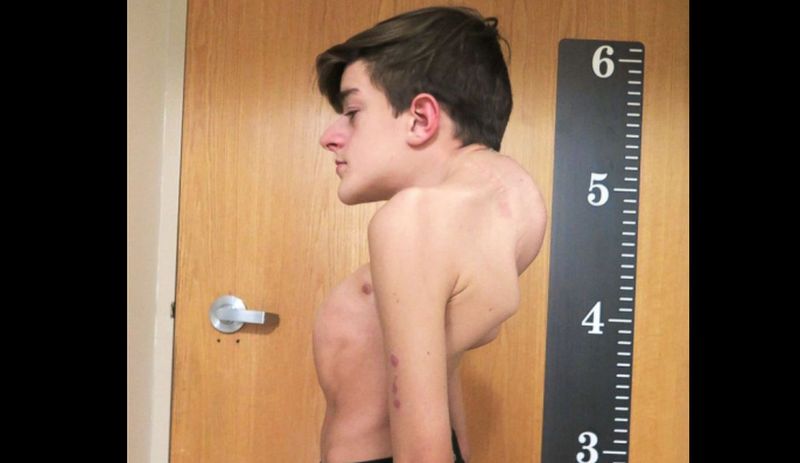 19-Year-Old Fighting Severe Scoliosis Has Miraculous Recovery