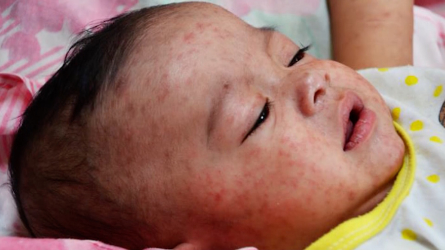 Measles Outbreak Grows in Northwest US, 31 Cases Reported