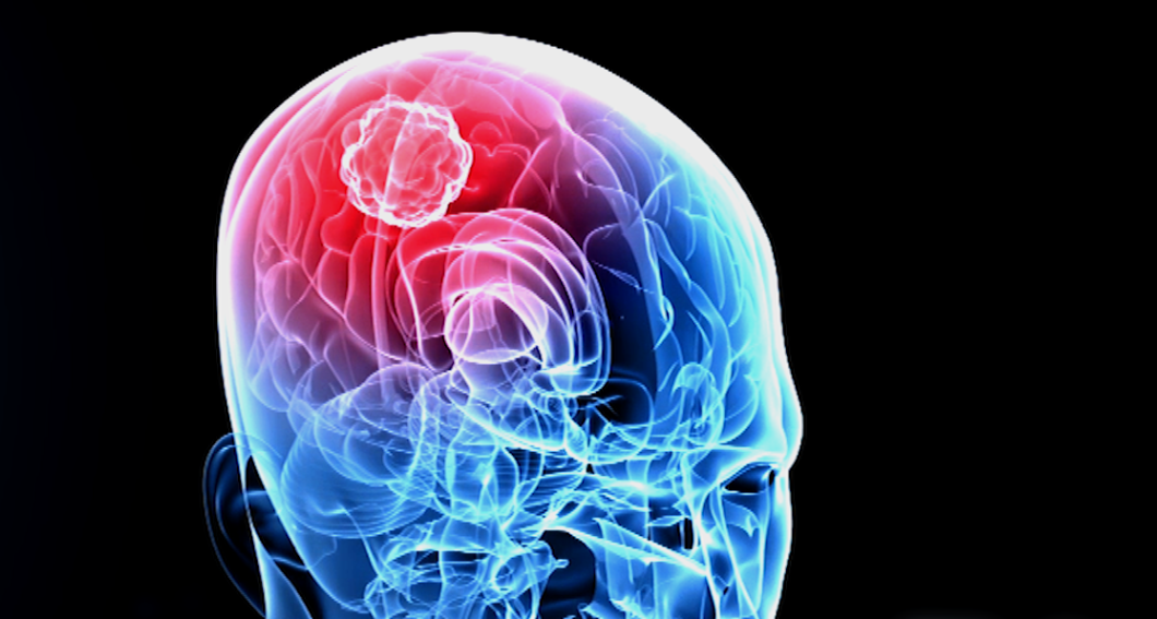 An illustration showing a brain with a tumor. (National Science Foundation)