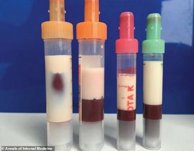 Man’s Blood Turns Milky After Poor Diet and Uncontrolled Diabetes Take Toll
