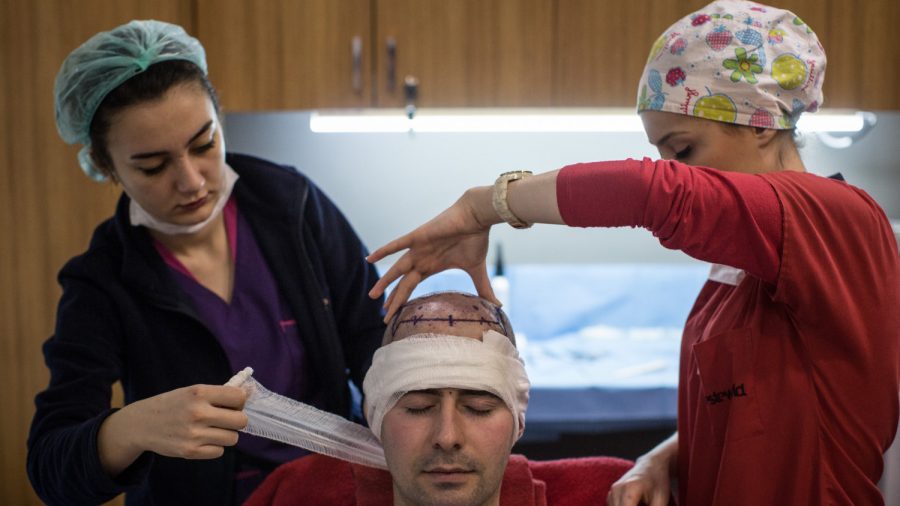 43-Year-Old Man Dies After Hair Transplant in India