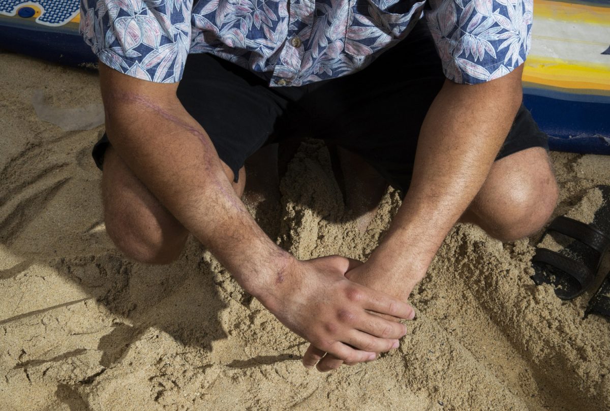 Juliun Perkins who was bitten by a shark on Sept. 8, 2018, while surfing outside of Pounders in Laie, sits on his surfboard that he was on during the attack, on Kailua beach in Oahu, Hawaii, on Feb. 22, 2019. (Cindy Ellen Russell/Honolulu Star-Advertiser via AP)