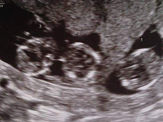 The boys are one in 3.2 million because two are identical, and share the same sac and placenta. (Claire Cerikci)