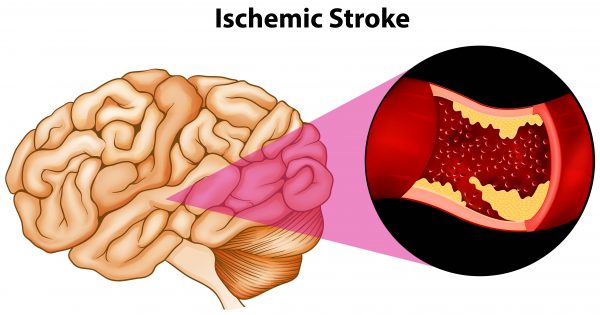 Ischemic stroke. (BlueRingMedia/Shutterstock)