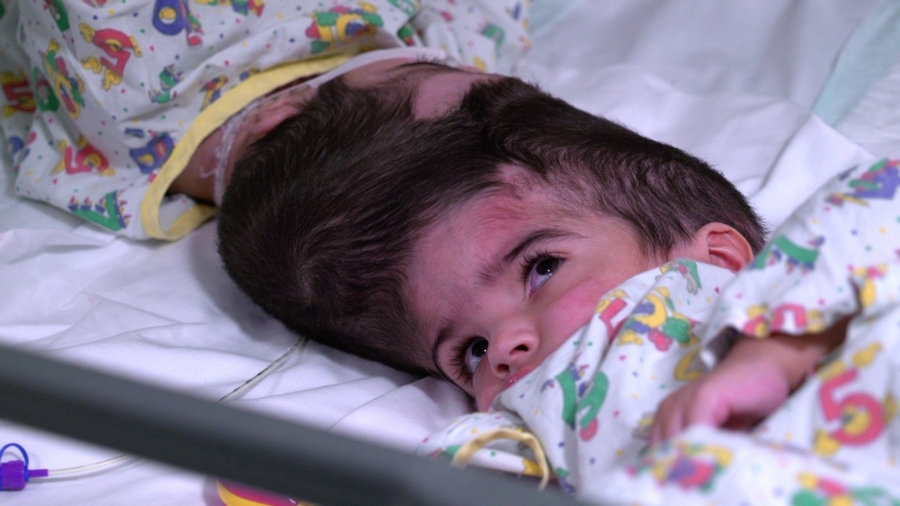 Sisters Conjoined at the Head Are Separated After 50 Hours of Surgery