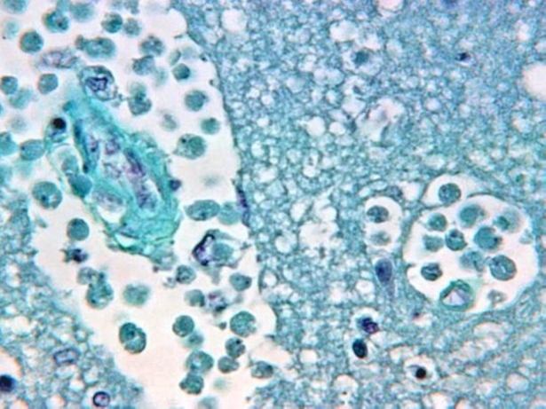 Brrain tissue that has been attacked by naegleria fowleri, also called "the brain-eating amoeba." (George R. Healy/CDC)