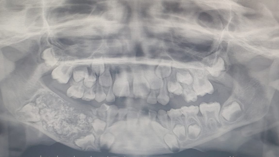 Doctors Find 526 Teeth in Boy’s Mouth in India