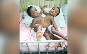 Nigerian Conjoined Twins Successfully Separated by 78-member Team in Abuja