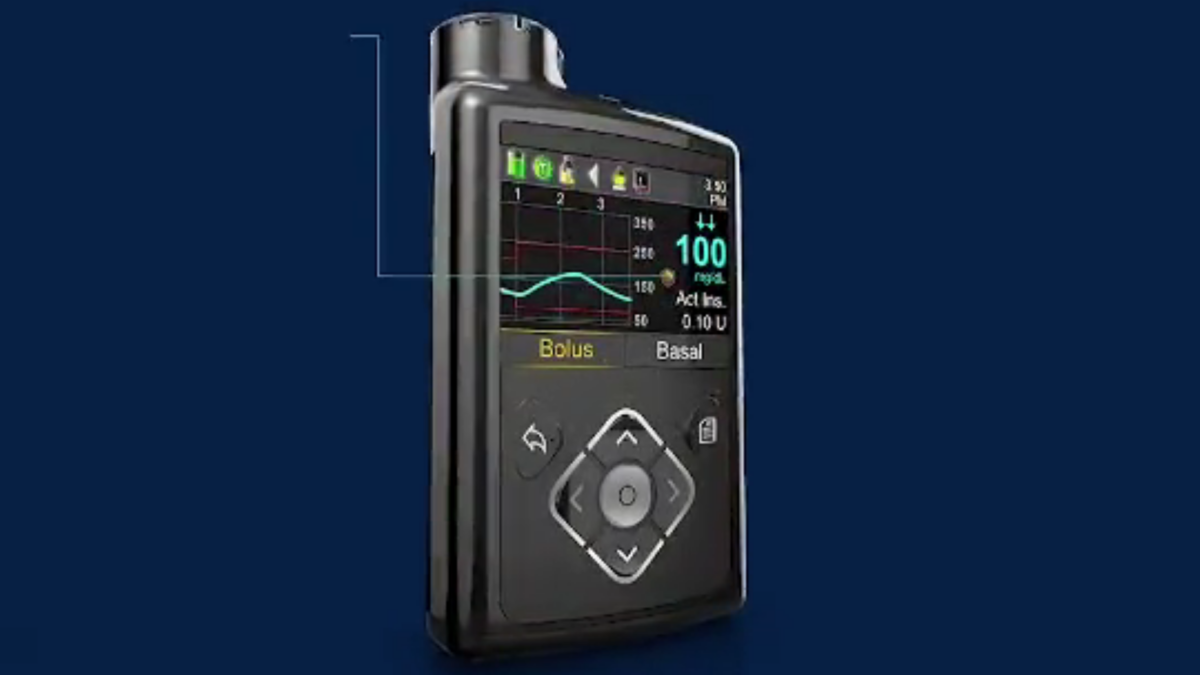 A MiniMed 630G insulin pump. (Courtesy of Medtronic)