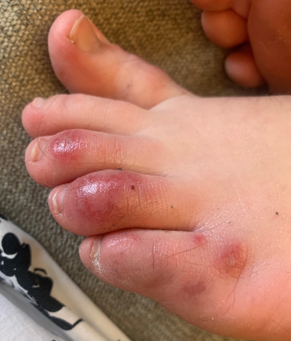 Discoloration on a teenage patient’s toes three days after the onset of the condition informally called “COVID toes” on April 6, 2020. (Courtesy of Dr. Amy Paller/Northwestern University via AP)
