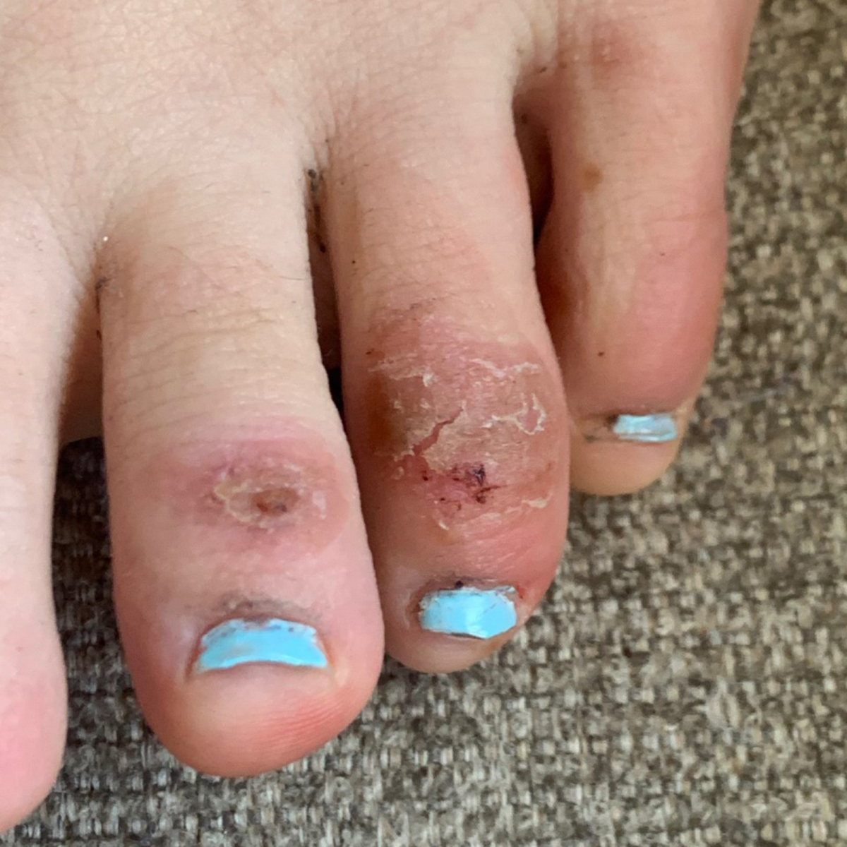 Discoloration on a teenage patient’s toes 4 weeks after the onset of the condition informally called “COVID toes” on April 21, 2020. (Courtesy of Dr. Amy Paller/Northwestern University via AP)