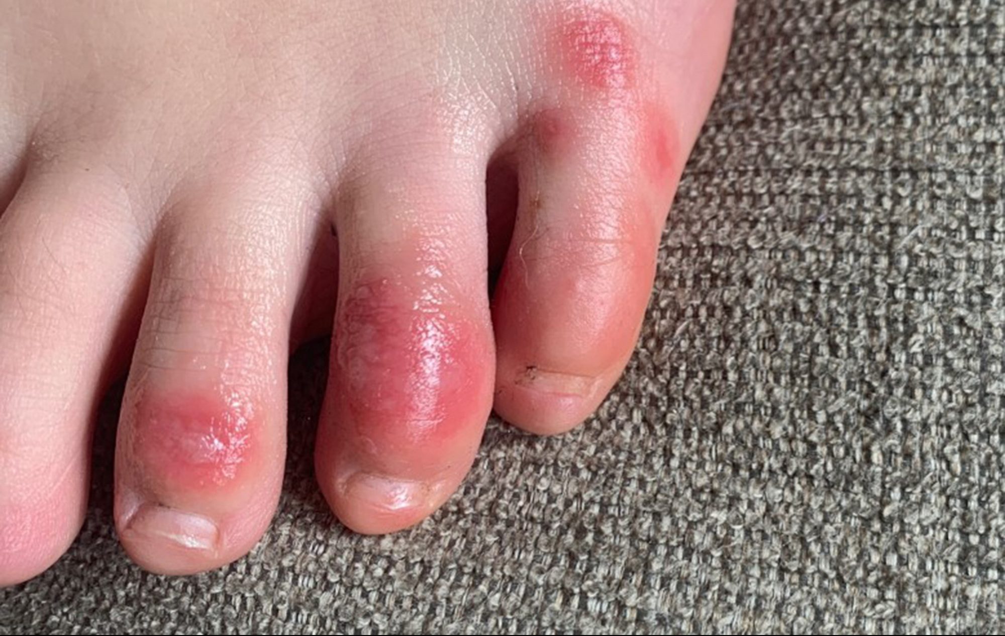 covid-toes-other-rashes-latest-possible-rare-virus-signs-ntd