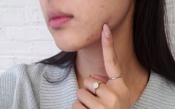 How to Reduce Acne Marks & Hyperpigmentation ft. @Peach & Lily