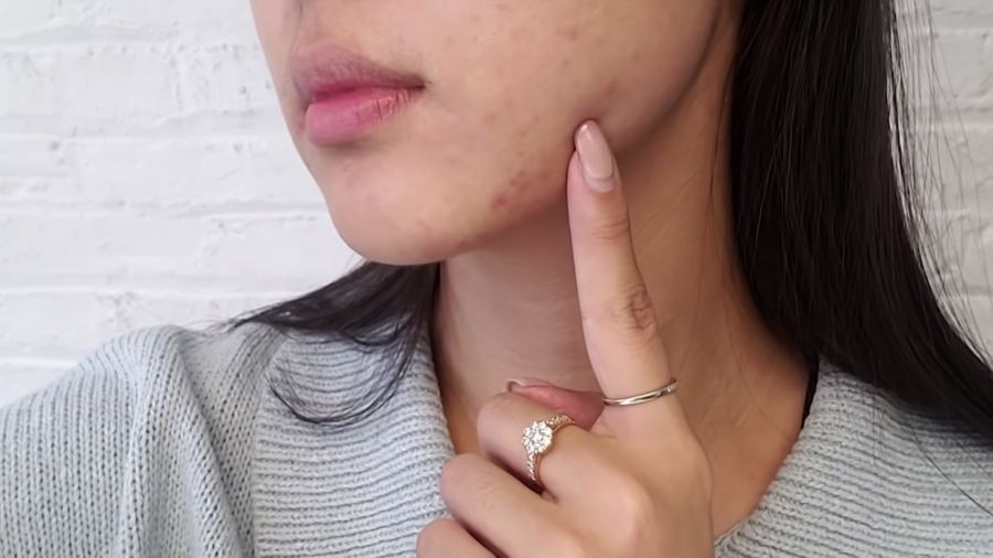How to Reduce Acne Marks & Hyperpigmentation ft. @Peach & Lily