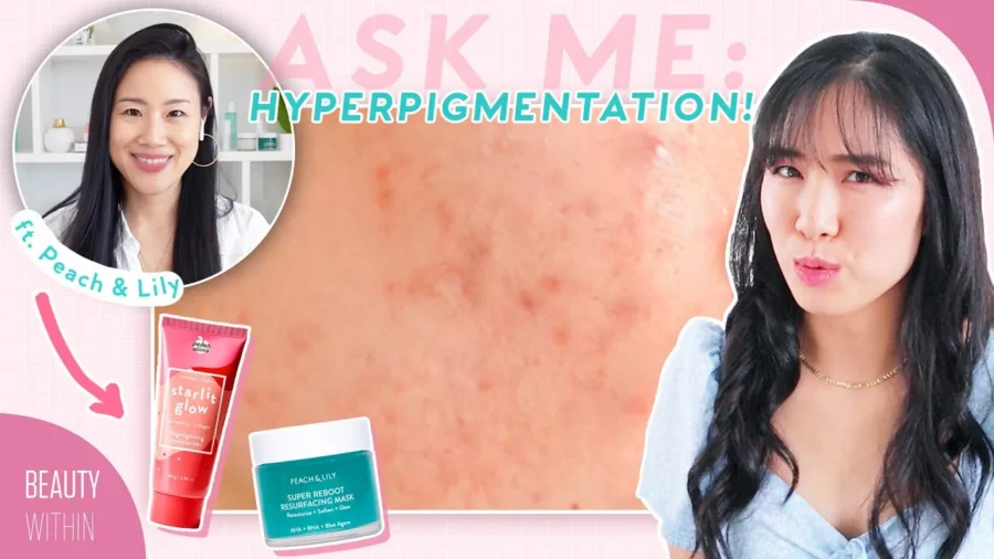 How to Reduce Acne Marks & Hyperpigmentation ft. @Peach & Lily