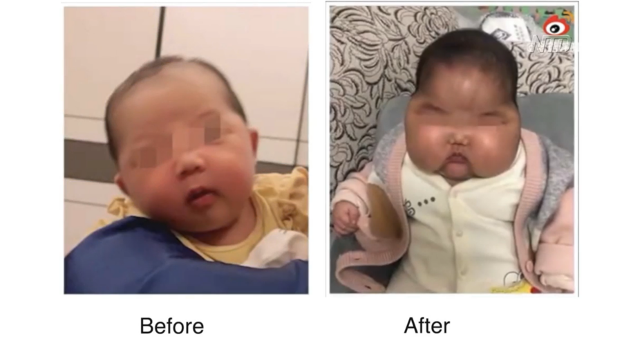 Baby Lotion Causes Deformities in China