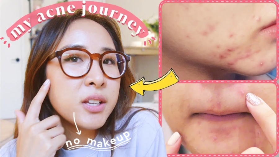 How I Cleared My Hormonal Acne, Naturally | 7-30 Day Plan You Can Try!