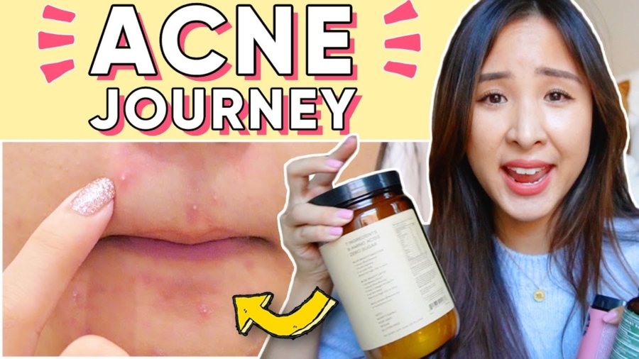 How I Used Food, Supplements, and Nutrition to Clear My Acne, Naturally