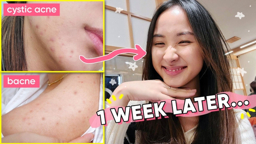 One Thing That Healed and Reset My Hormonal Acne, Naturally | Acne Series
