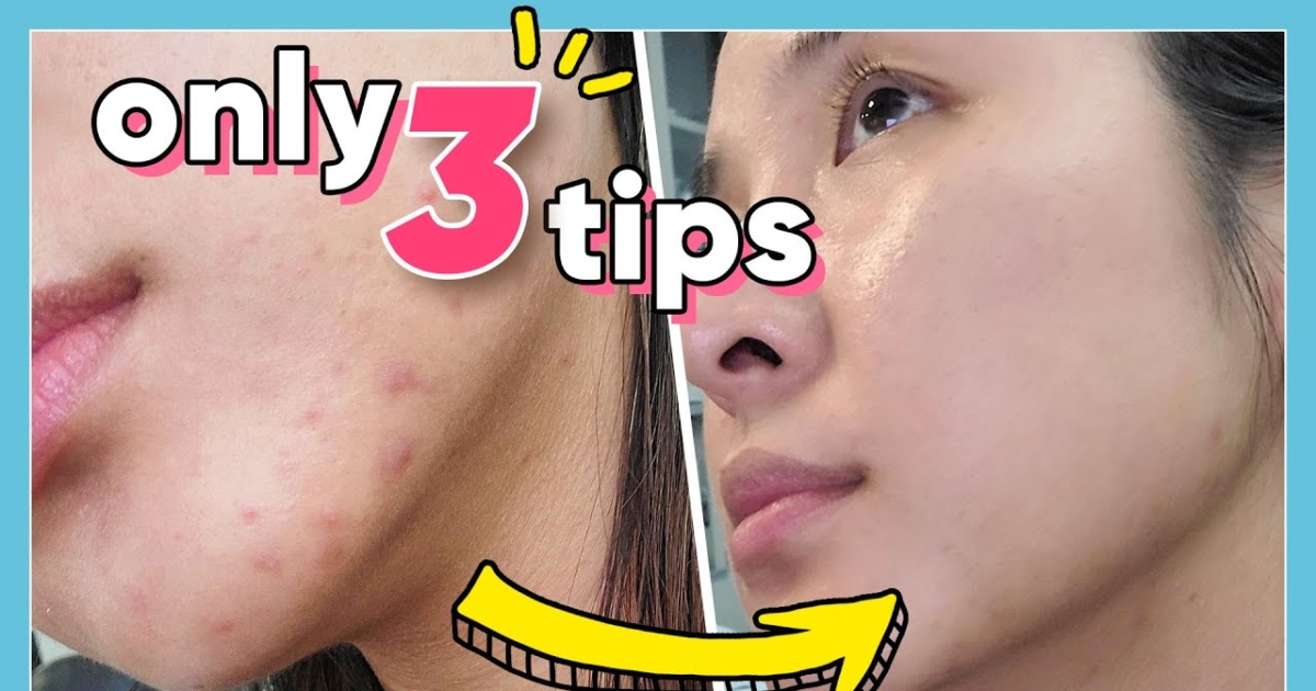 Its Important 3 Quick And Simple Ways To Get Rid Of Pimples Ntd 