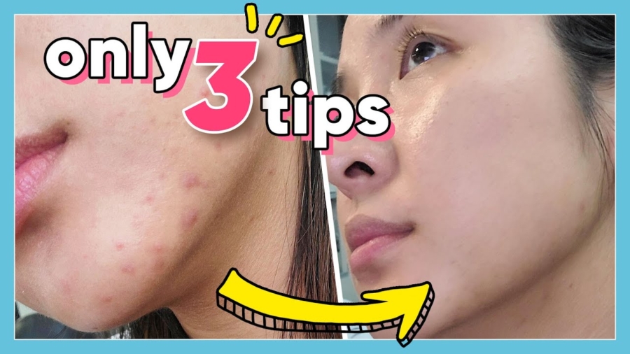 It's Important: 3 Quick and Simple Ways to Get Rid of Pimples!