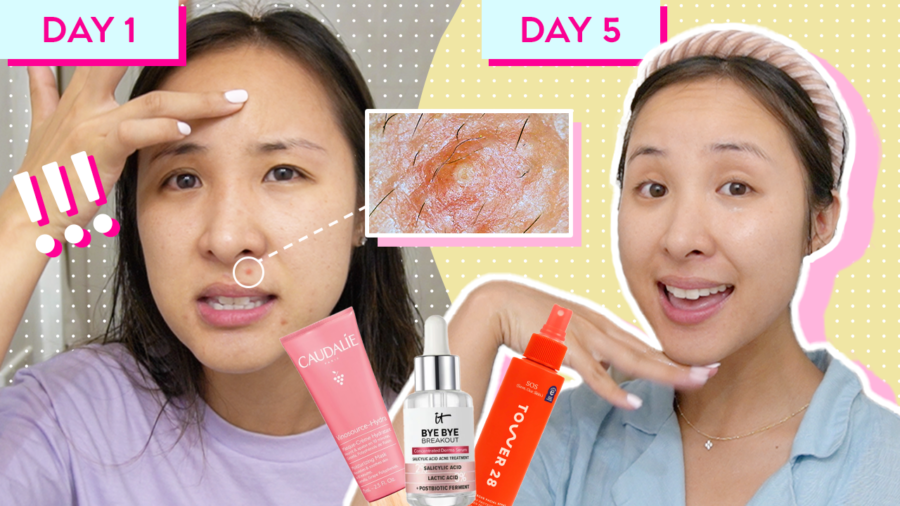 My (Hormonal) Acne Came Back—Here's What I Did