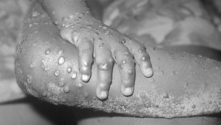 Doctor: Monkeypox Outbreak's Suspicious Pattern