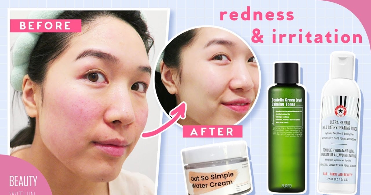 Best 5 Ingredients to Avoid Skin Inflammation & Irritation! NTD