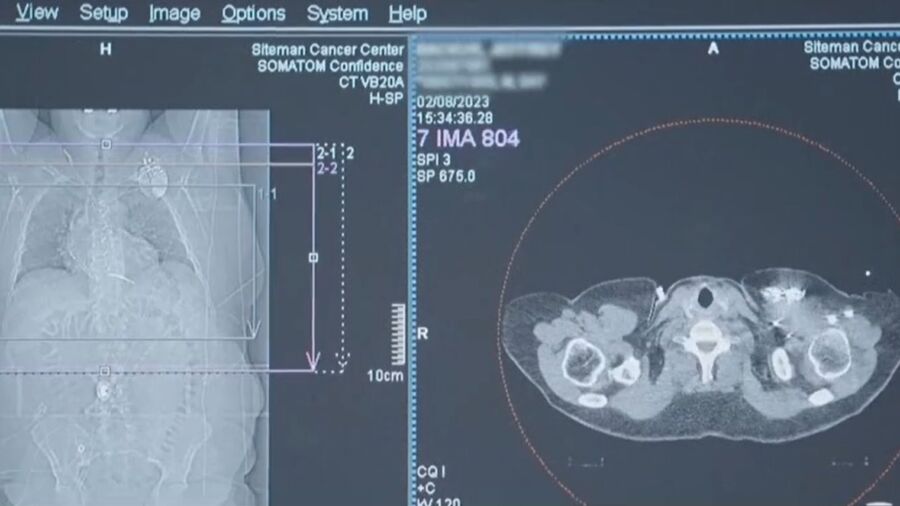 Doctors Use Radiation to Treat Heart Condition