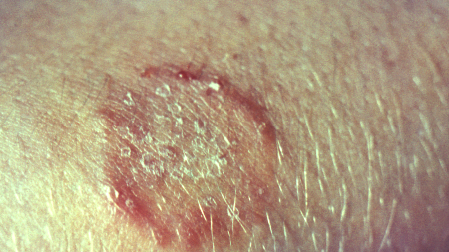 First Ever US Cases of Severe, Contagious, Drug-Resistant Ringworm Reported