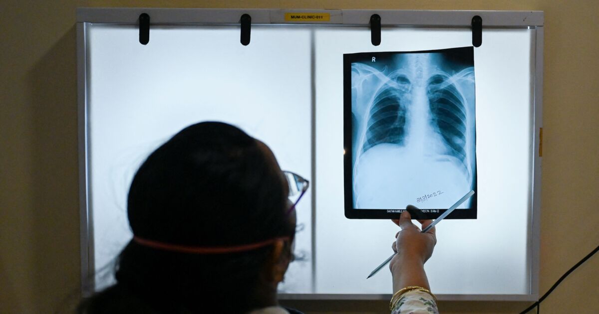 Illegal Immigrant Children With Tuberculosis Released Across US NTD   Id931946 Chest X Rays For Tuberculosis 1200x630 