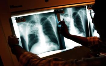 A doctor examines the x-rays of a tuberculosis patient in a file image. (Spencer Platt/Getty Images)