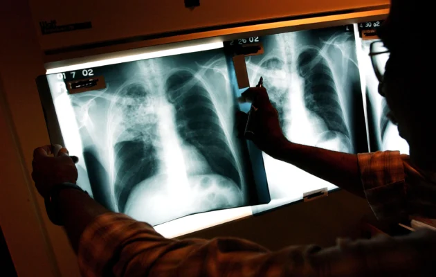 A doctor examines the x-rays of a tuberculosis patient in a file image. (Spencer Platt/Getty Images)