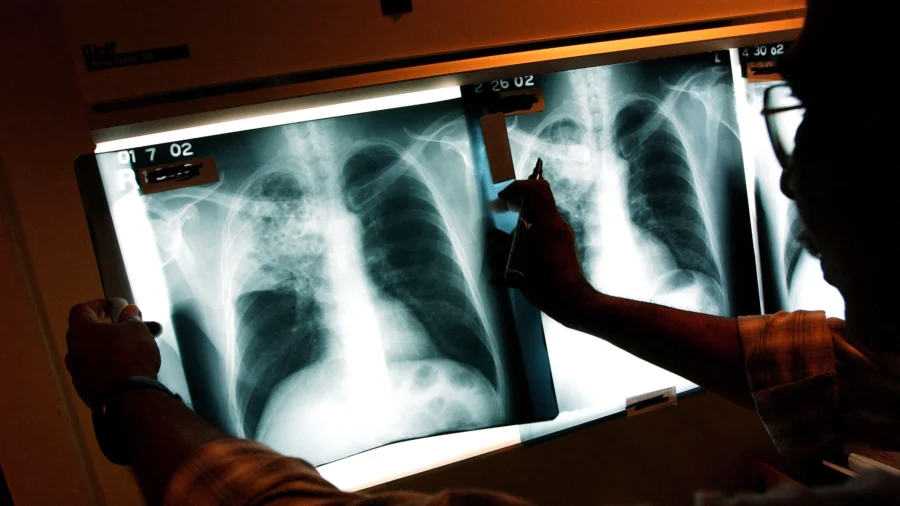 Emergency Declared on Tuberculosis in California City