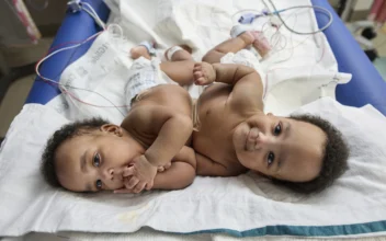 Twins Born Conjoined Celebrate 1st Birthday After Separation Surgery