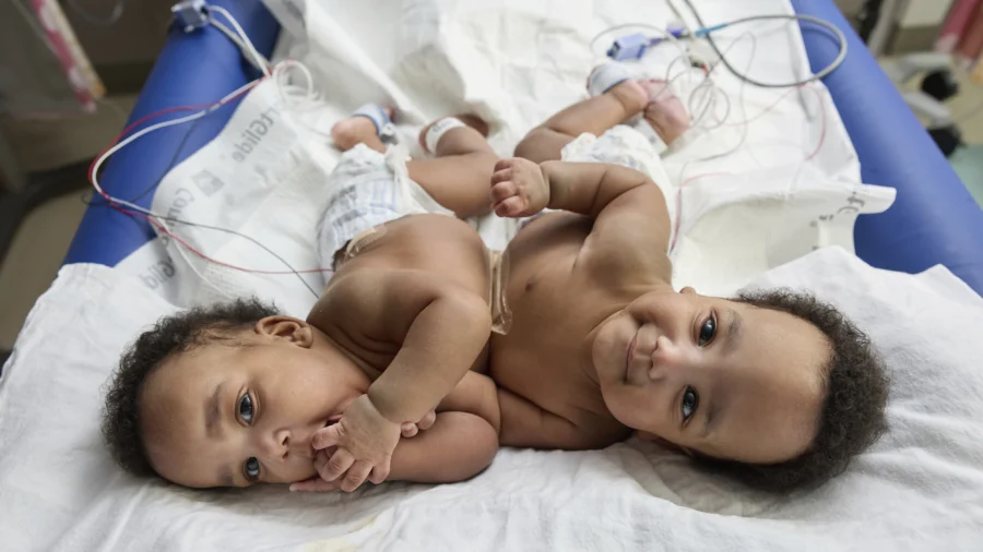 Twins Born Conjoined Celebrate 1st Birthday After Separation Surgery