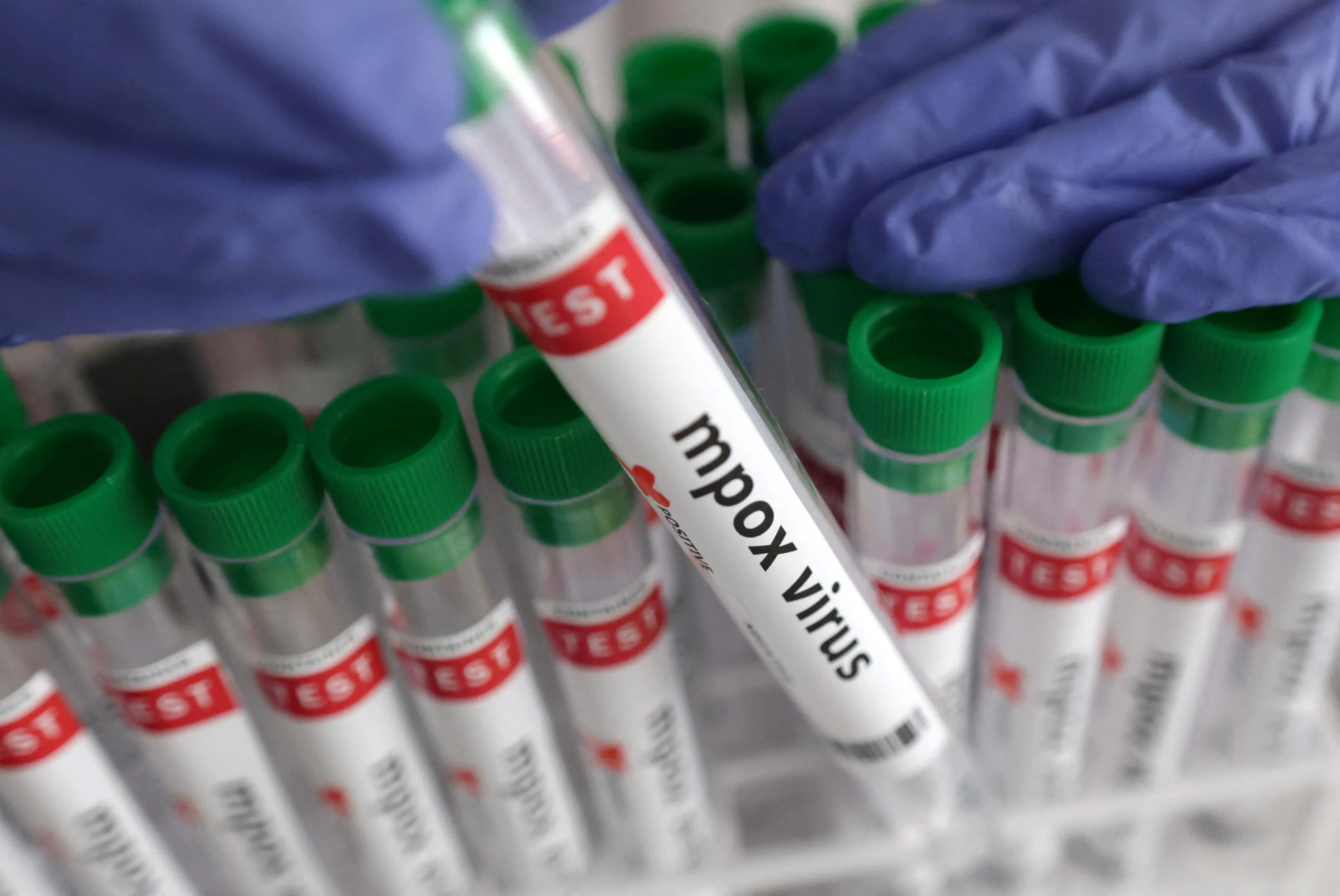 3rd Mpox Case Signals Possible Local Transmission in California