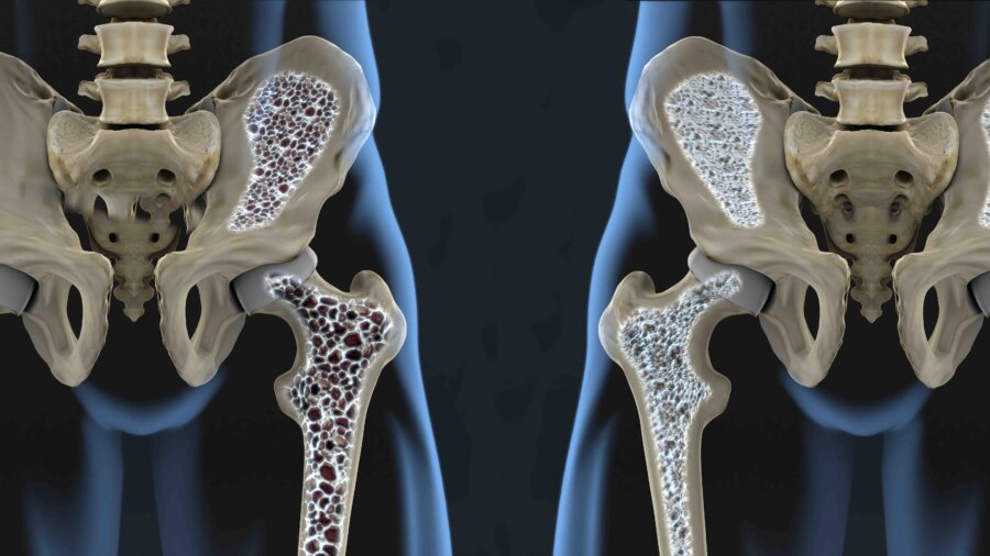 Diagnosed at 32, Expert Shares Osteoporosis Prevention Tips
