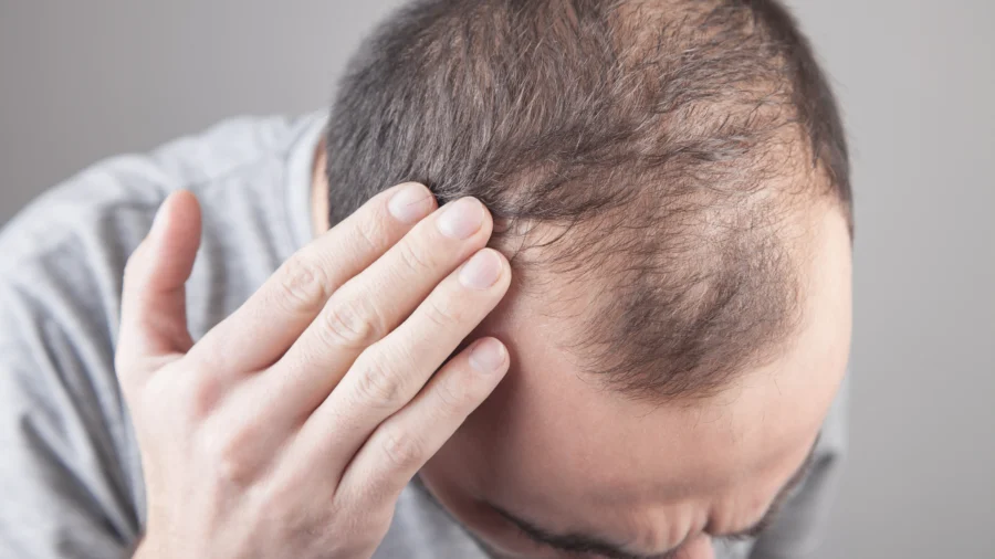 Losing Hair? Going Bald? Can it Really be Stopped?–Natural and Medical Methods