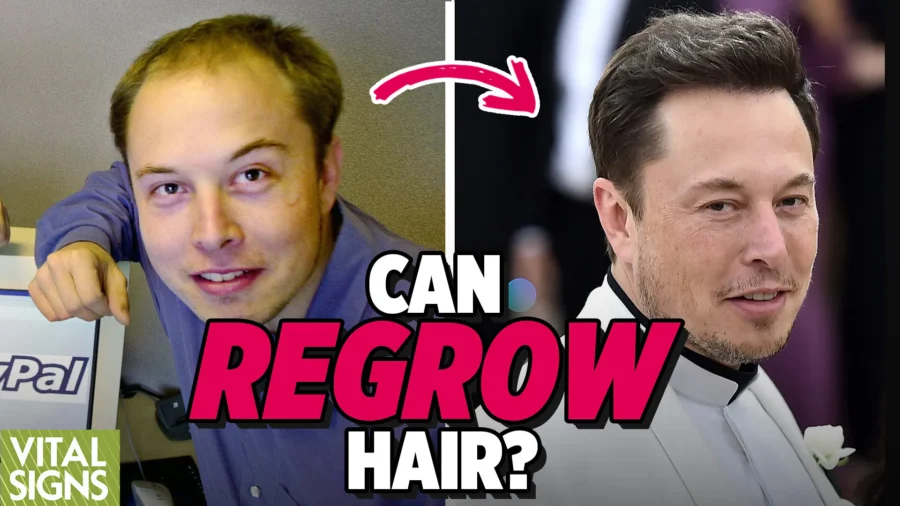 Losing Hair? Going Bald? Can it Really be Stopped?–Natural and Medical Methods