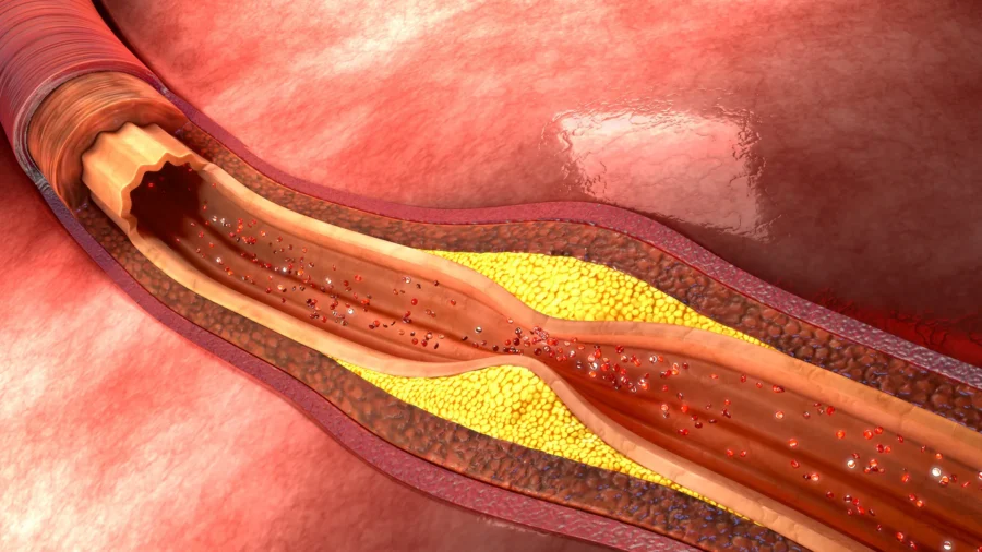 Does Reducing Saturated Fats Impact Hypertension, Cholesterol, and Overall Health?