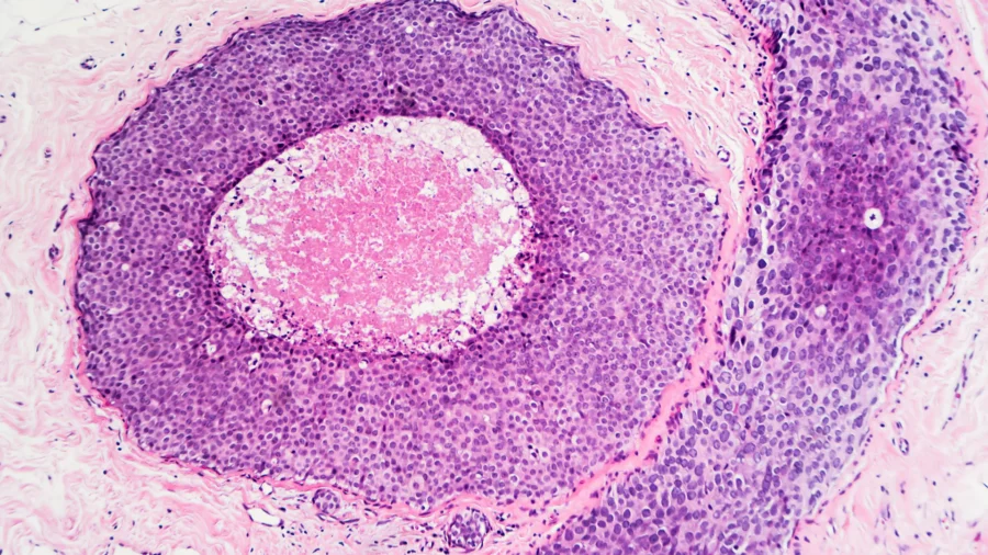 Can Hormone Therapy Prevent Breast Cancer and Boost Women’s (and Men’s) Health?