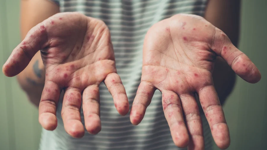 Did the MMR Vax Really End Measles in the US? How Do Vaxxed Kids Compare to Unvaxxed Kids in Health?