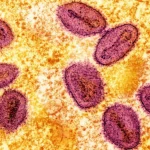 First Locally Acquired US Case of Severe Mpox Strain Identified in California