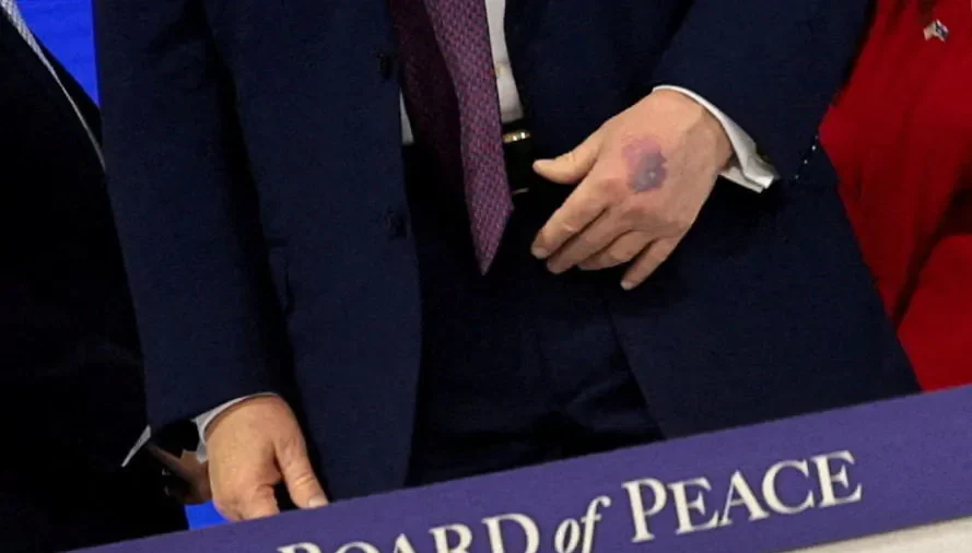 Trump Attributes New Bruise on Hand to Aspirin Consumption
